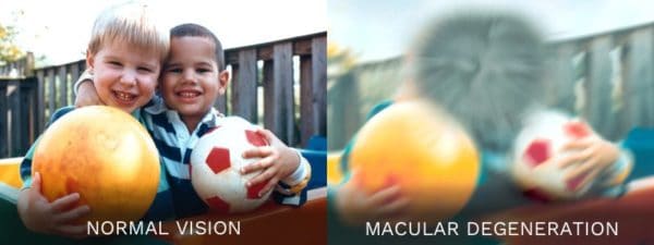 Macular degeneration
